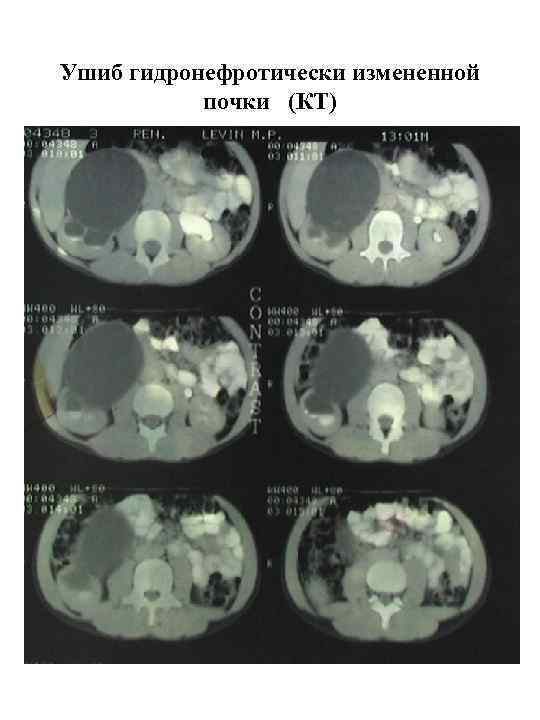 Ушиб гидронефротически измененной почки (КТ) 