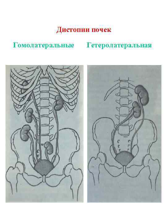 Дистопии почек Гомолатеральные Гетеролатеральная 