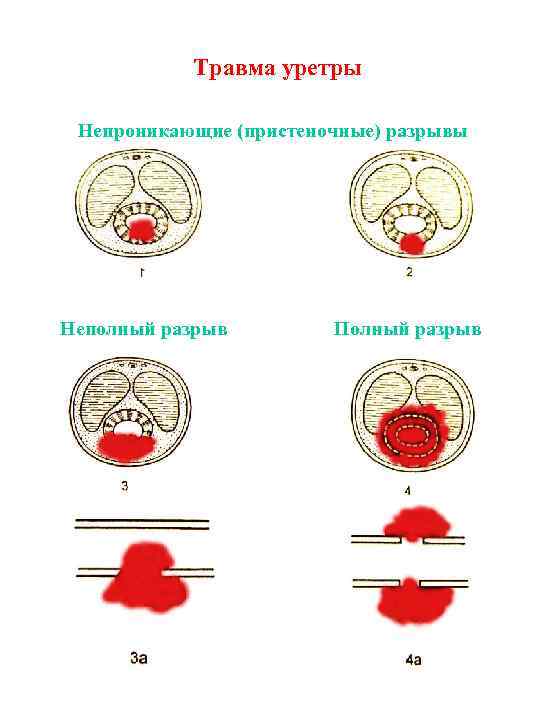 Травма уретры Непроникающие (пристеночные) разрывы Неполный разрыв Полный разрыв 
