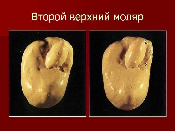 Второй верхний моляр 