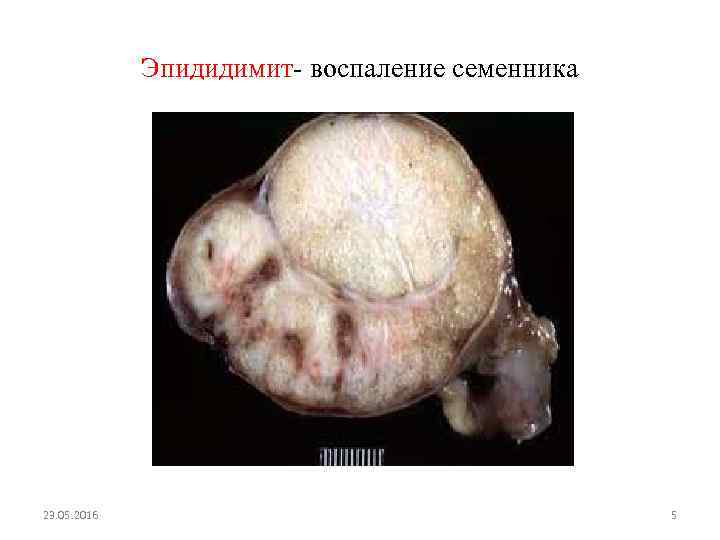 Эпидидимит- воспаление семенника 23. 05. 2016 5 