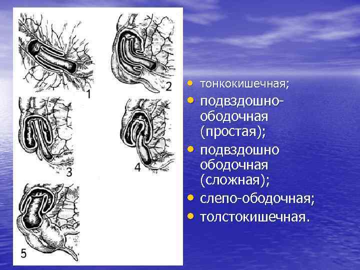  • тонкокишечная; • подвздошноободочная (простая); • подвздошно ободочная (сложная); • слепо-ободочная; • толстокишечная.