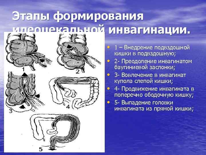 Этапы формирования илеоцекальной инвагинации. • 1 – Внедрение подвздошной • • кишки в подвздошную;