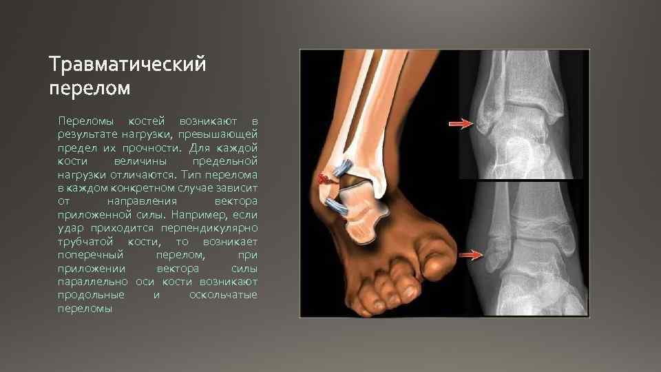 Переломы костей возникают в результате нагрузки, превышающей предел их прочности. Для каждой кости величины