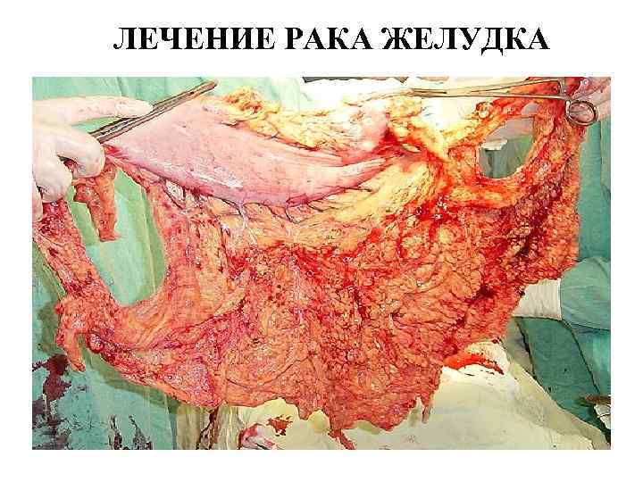 ЛЕЧЕНИЕ РАКА ЖЕЛУДКА 