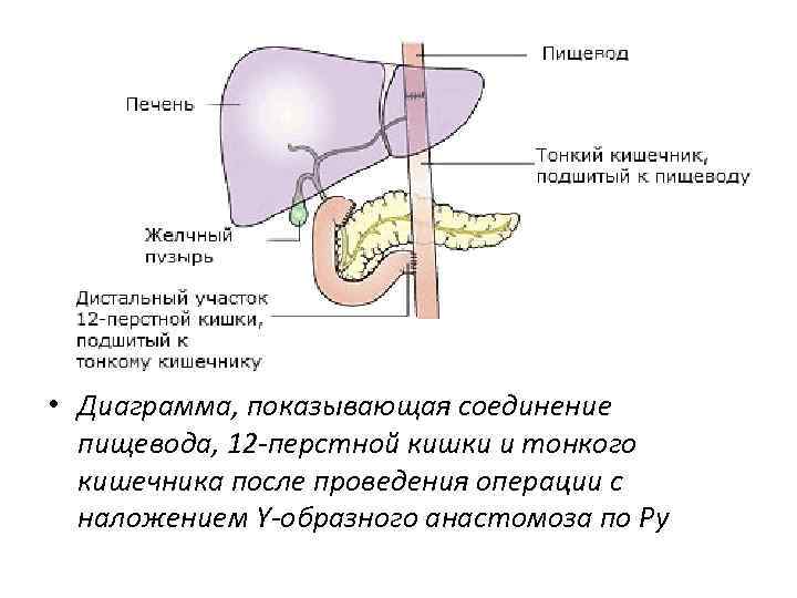  • Диаграмма, показывающая соединение пищевода, 12 -перстной кишки и тонкого кишечника после проведения