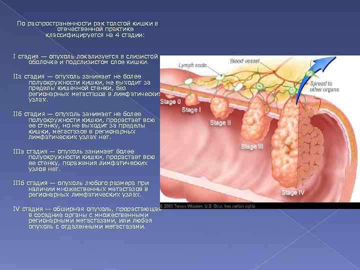 По распространенности рак толстой кишки в отечественной практике классифицируется на 4 стадии: I стадия