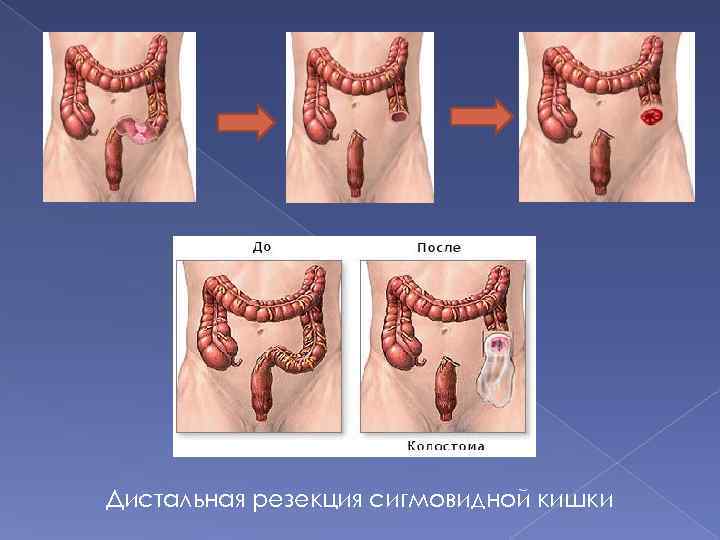 Дистальная резекция сигмовидной кишки 