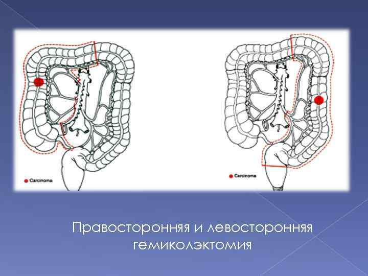 Правосторонняя и левосторонняя гемиколэктомия 