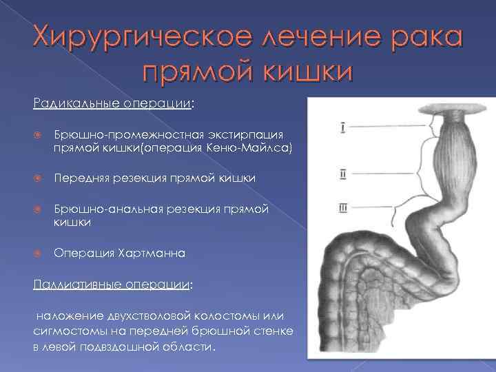 Хирургическое лечение рака прямой кишки Радикальные операции: Брюшно-промежностная экстирпация прямой кишки(операция Кеню-Майлса) Передняя резекция