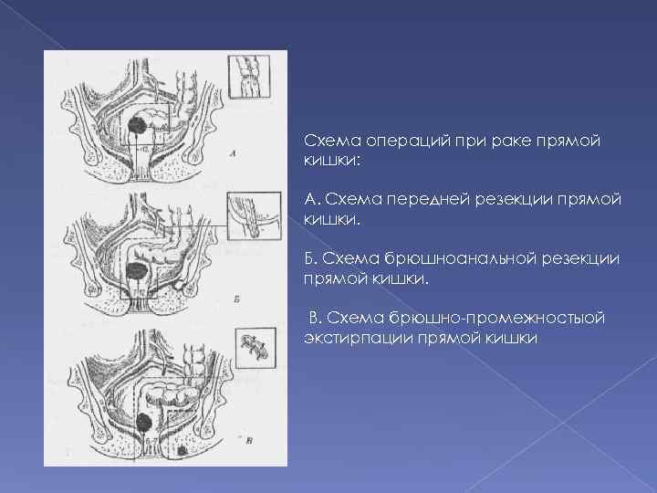 Схема операций при раке прямой кишки: А. Схема передней резекции прямой кишки. Б. Схема