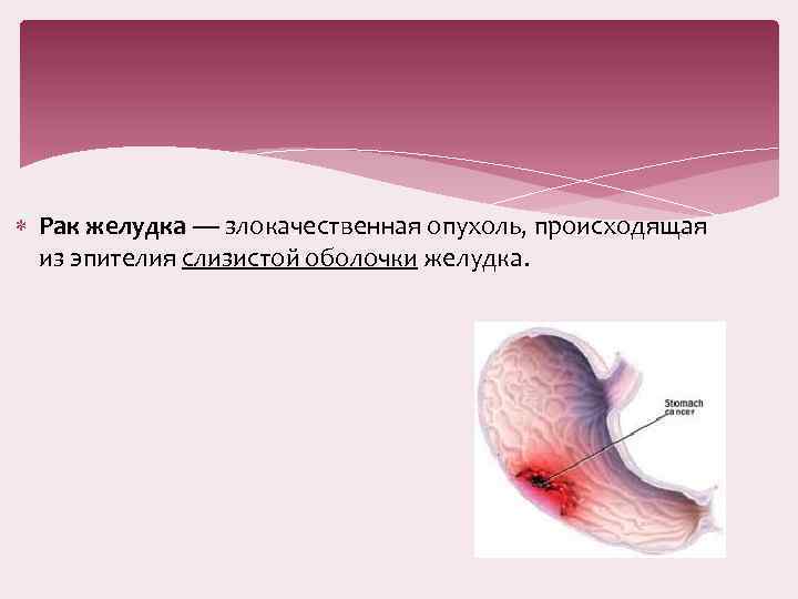  Рак желудка — злокачественная опухоль, происходящая из эпителия слизистой оболочки желудка. 