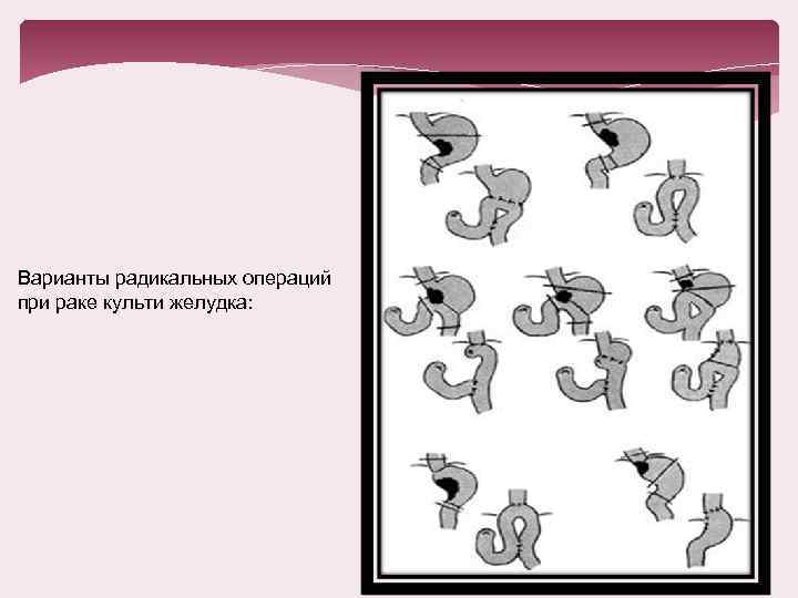 Варианты радикальных операций при раке культи желудка: 