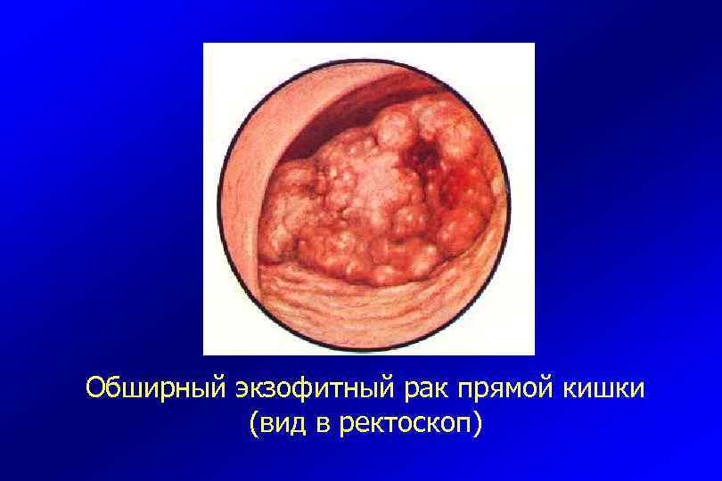 Обширный экзофитный рак прямой кишки (вид в ректоскоп) 