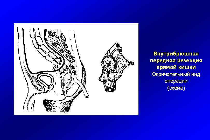 Ткань прямой кишки