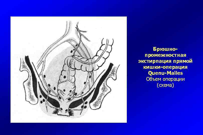 Операция герлока схема