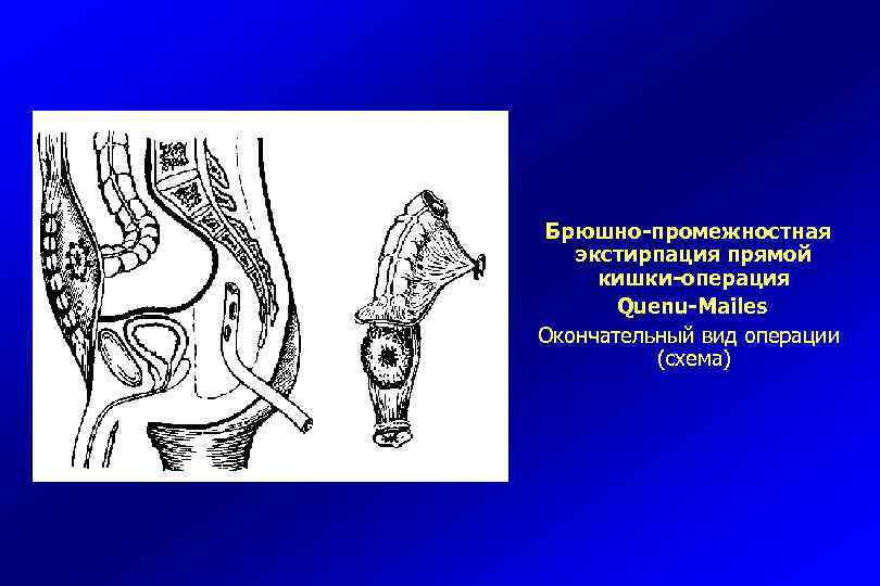 Облучение прямой кишки схема лечения