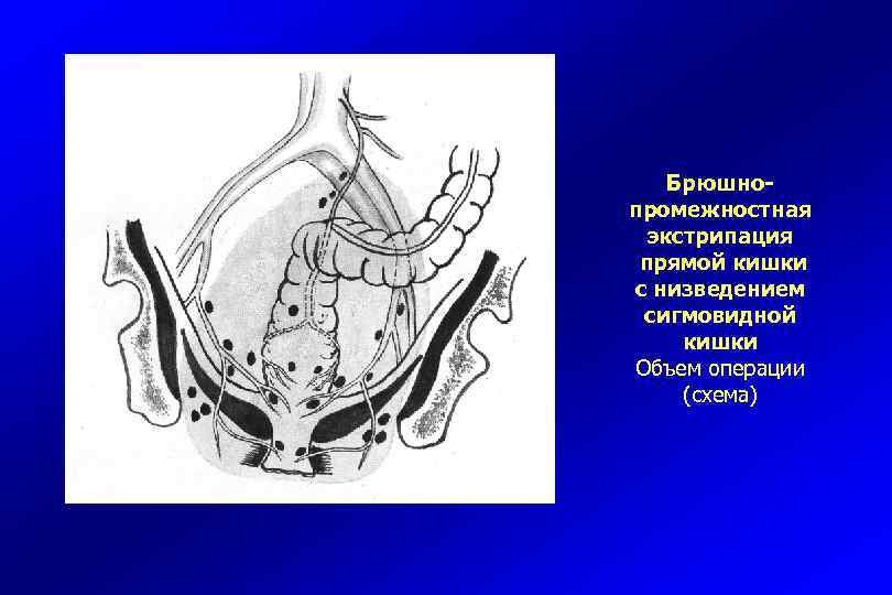 Брюшнопромежностная экстрипация прямой кишки с низведением сигмовидной кишки Объем операции (схема) 