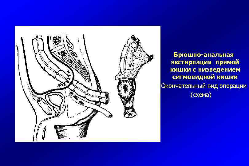 Укрепление прямой кишки