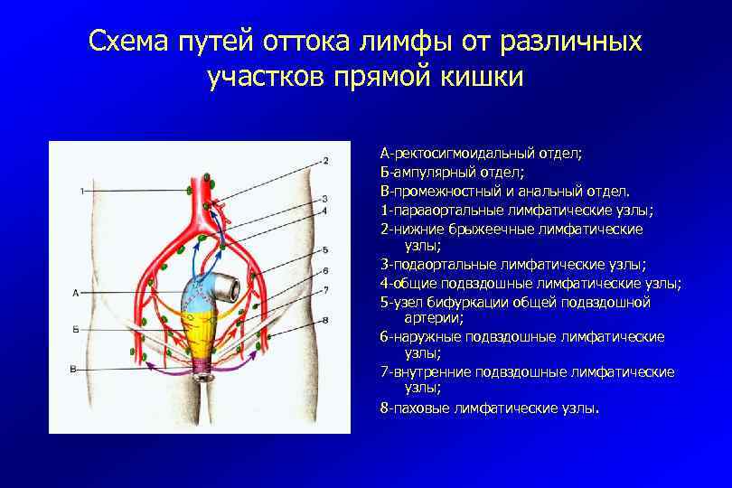 Схема путей оттока лимфы от различных участков прямой кишки А-ректосигмоидальный отдел; Б-ампулярный отдел; В-промежностный