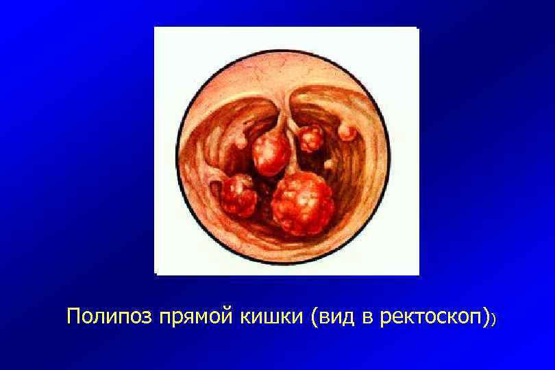 Полипоз прямой кишки (вид в ректоскоп)) 