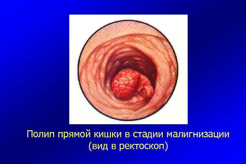 Полип прямой кишки в стадии малигнизации (вид в ректоскоп) 