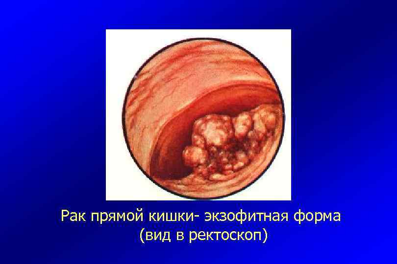 Рак прямой кишки- экзофитная форма (вид в ректоскоп) 
