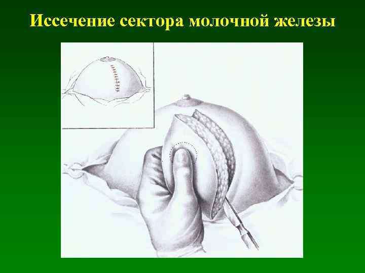 Иссечение сектора молочной железы 