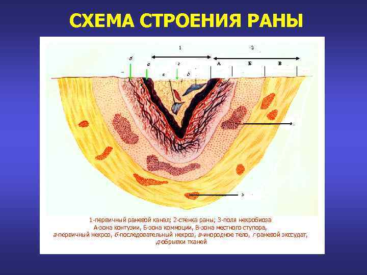 СХЕМА СТРОЕНИЯ РАНЫ 1 б 2 г а в А Б В д 3