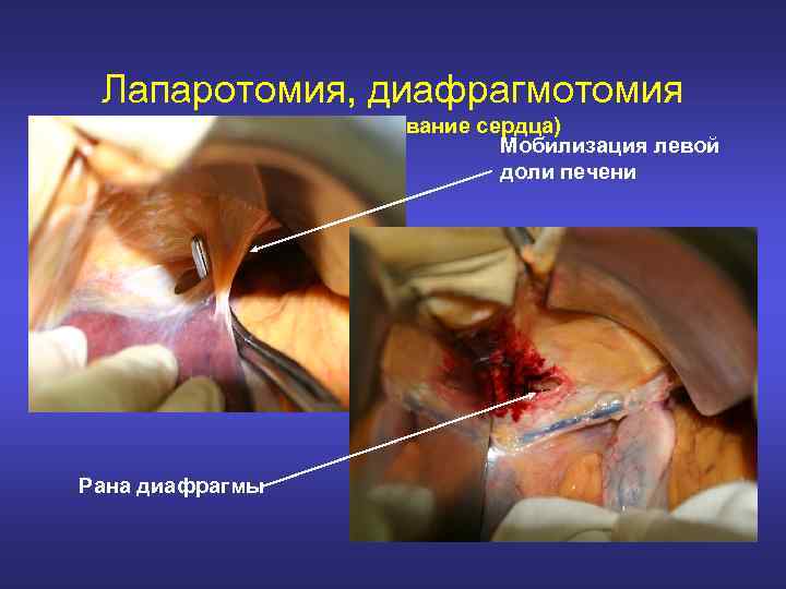 Лапаротомия, диафрагмотомия (у 7 из них – ушивание сердца) Мобилизация левой доли печени Рана