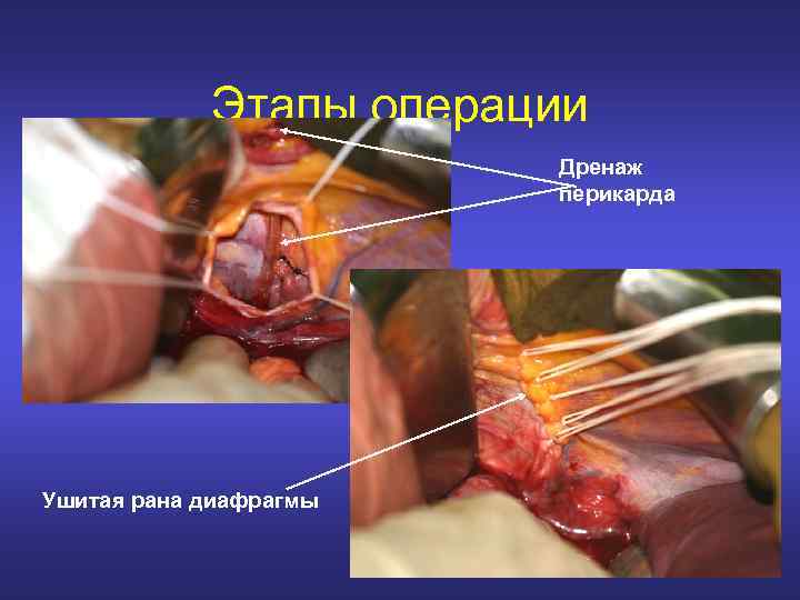 Этапы операции Дренаж перикарда Ушитая рана диафрагмы 