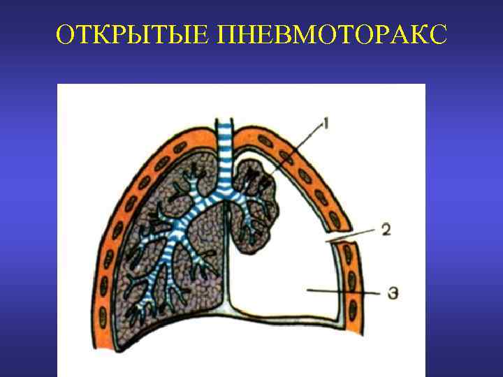 ОТКРЫТЫЕ ПНЕВМОТОРАКС 