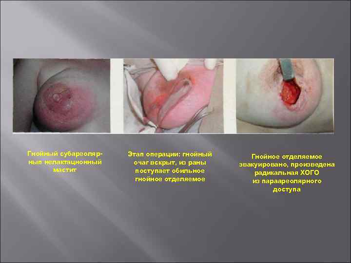 Гнойный субареолярнып нелактацнонный мастит Этап операции: гнойный очаг вскрыт, из раны поступает обильное гнойное