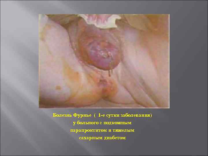 Болезнь Фурнье ( 1 -е сутки заболевания) у больного с подкожным парапроктитом и тяжелым