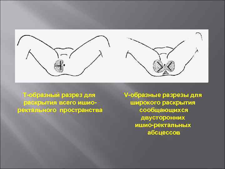 Т-образный разрез для раскрытия всего ишиоректального пространства V-образные разрезы для широкого раскрытия сообщающихся двусторонних