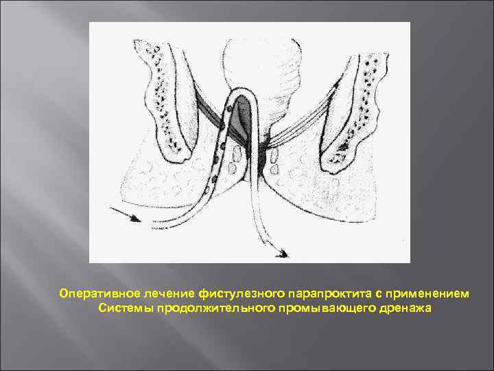 Клиническая картина ректального свища характеризуется