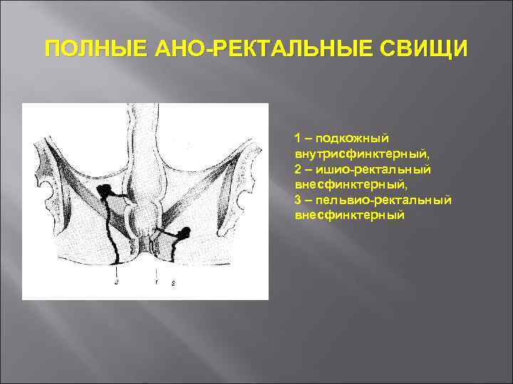 ПОЛНЫЕ АНО-РЕКТАЛЬНЫЕ СВИЩИ 1 – подкожный внутрисфинктерный, 2 – ишио-ректальный внесфинктерный, 3 – пельвио-ректальный