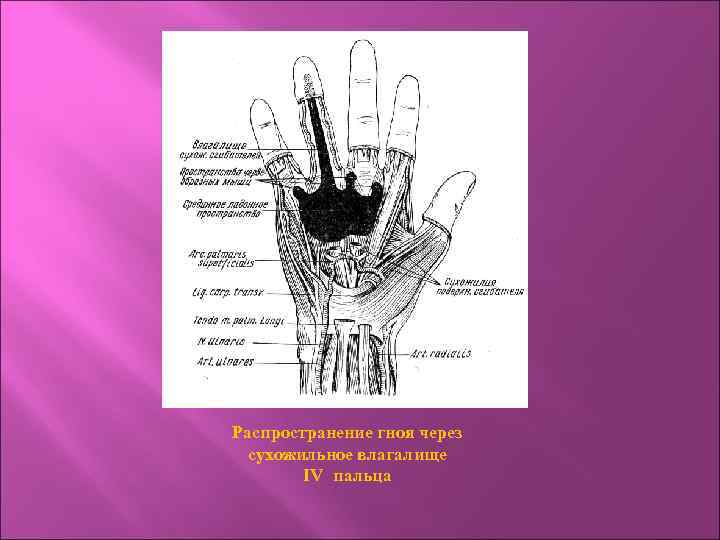 Распространение гноя через сухожильное влагалище IV пальца 