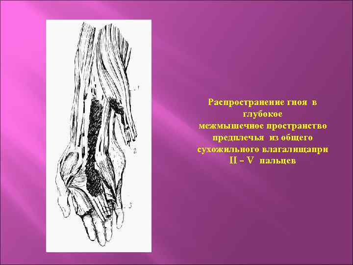 Распространение гноя в глубокое межмышечное пространство предплечья из общего сухожильного влагалищапри II – V
