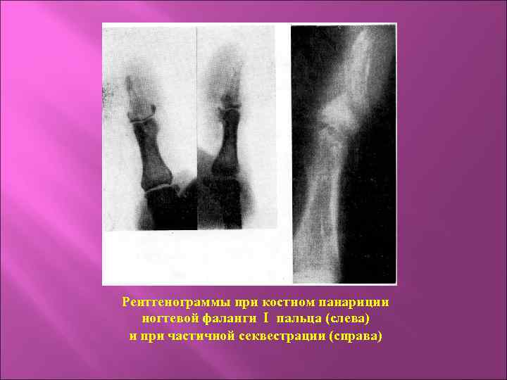 Рентгенограммы при костном панариции ногтевой фаланги I пальца (слева) и при частичной секвестрации (справа)