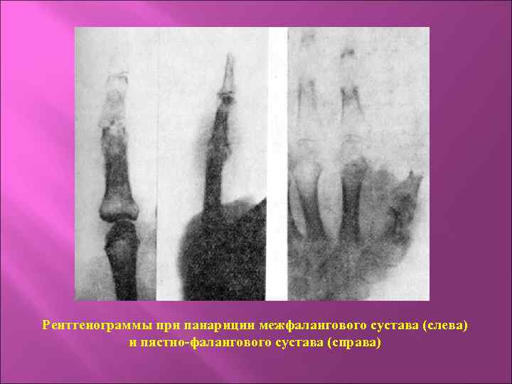 Рентгенограммы при панариции межфалангового сустава (слева) и пястно-фалангового сустава (справа) 