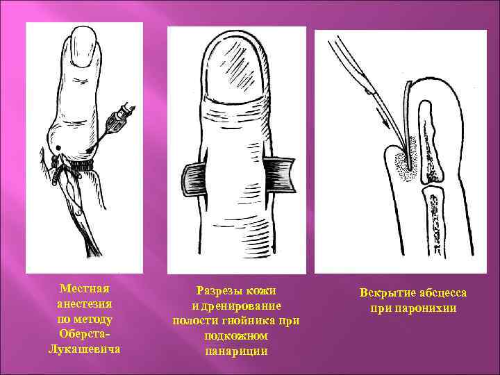 Местная анестезия по методу Оберста. Лукашевича Разрезы кожи и дренирование полости гнойника при подкожном