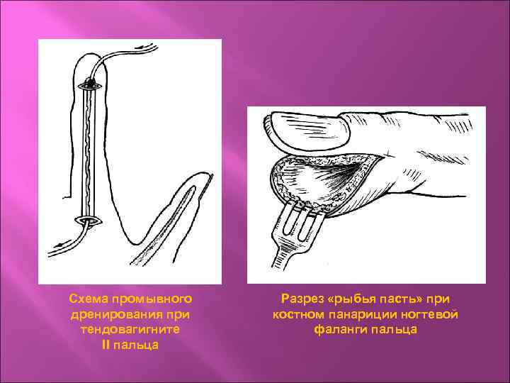 Схема промывного дренирования при тендовагигните II пальца Разрез «рыбья пасть» при костном панариции ногтевой