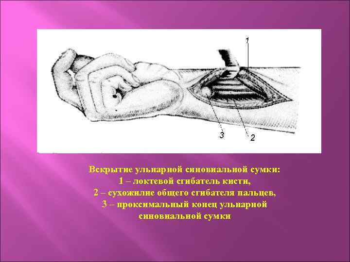 Вскрытие ульнарной синовиальной сумки: 1 – локтевой сгибатель кисти, 2 – сухожилие общего сгибателя