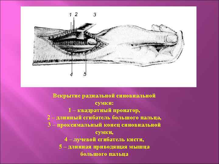 Вскрытие радиальной синовиальной сумки: 1 – квадратный пронатор, 2 – длинный сгибатель большого пальца,