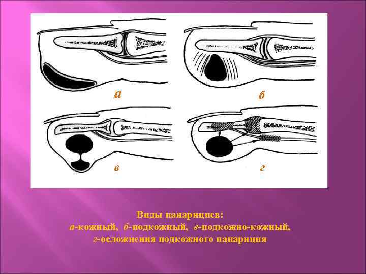 а б в г Виды панарициев: а-кожный, б-подкожный, в-подкожно-кожный, г-осложнения подкожного панариция 