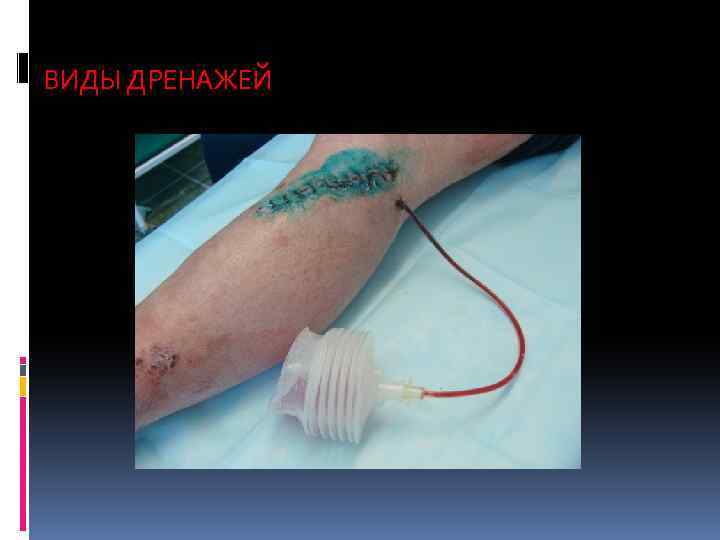 ВИДЫ ДРЕНАЖЕЙ 