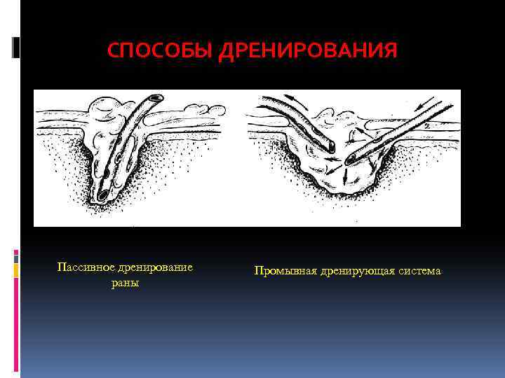 Картинки дренирование раны