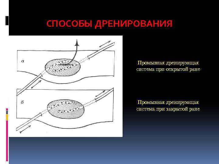 СПОСОБЫ ДРЕНИРОВАНИЯ Промывная дренирующая система при открытой ране Промывная дренирующая система при закрытой ране