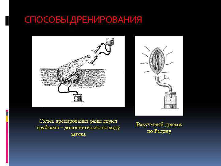 Картинки дренирование раны